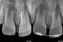 TRAUMATISMO DENTOALVEOLAR FSCOE CURSO